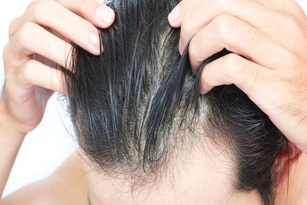 什么是毛發(fā)移植 毛發(fā)移植安全嗎 什么是毛發(fā)移植 毛發(fā)移植安全嗎