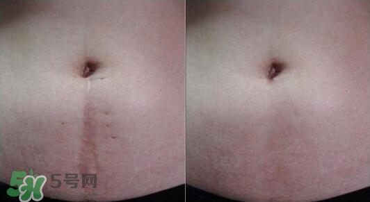 祛疤痕最好的方法有哪些？祛疤痕的簡單方法
