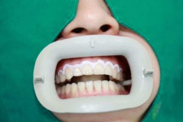 牙齒發(fā)黃應(yīng)該怎么辦 解決牙齒發(fā)黃的方法 牙齒發(fā)黃應(yīng)該怎么辦 解決牙齒發(fā)黃的方法