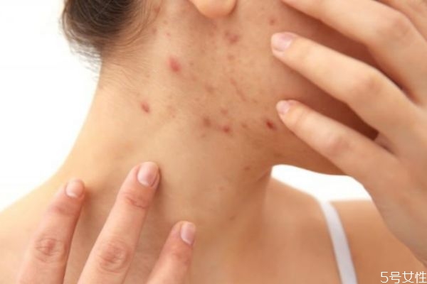 脖子上喜歡長痘痘是怎么回事 脖子上長痘痘原因 脖子上喜歡長痘痘是怎么回事 脖子上長痘痘原因