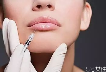 嘴唇打玻尿酸好不好 玻尿酸豐唇幾天最好看 嘴唇打玻尿酸好不好 玻尿酸豐唇幾天最好看