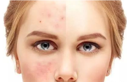 刷酸后怎么洗臉 刷完酸多久能用清潔面膜 刷酸后怎么洗臉 刷完酸多久能用清潔面膜