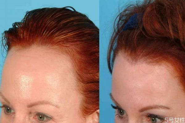 發(fā)際線后移是為什么 發(fā)際線不好看該怎么修飾 發(fā)際線后移是為什么 發(fā)際線不好看該怎么修飾