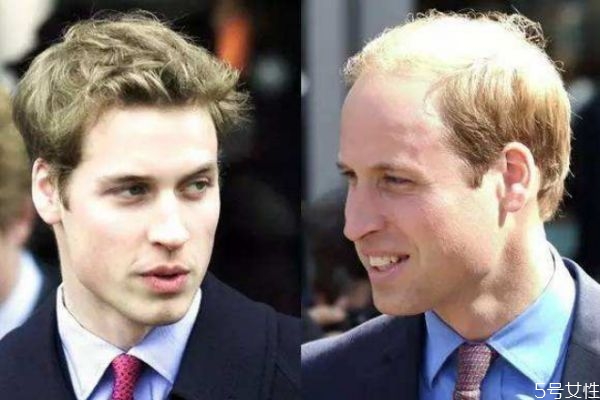 發(fā)際線后移是為什么 發(fā)際線不好看該怎么修飾 發(fā)際線后移是為什么 發(fā)際線不好看該怎么修飾