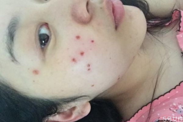 激光去痣后要注意什么 激光美容有哪些危害 激光去痣后要注意什么 激光美容有哪些危害