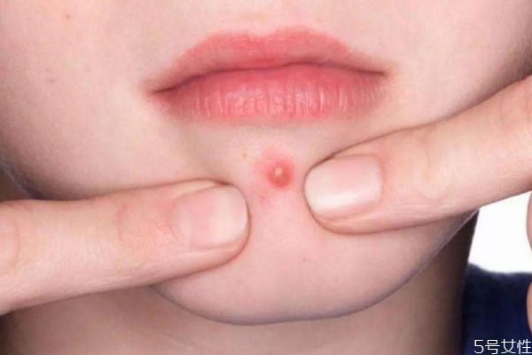 如何正確擠痘 你會正確的擠痘痘嗎 如何正確擠痘 你會正確的擠痘痘嗎