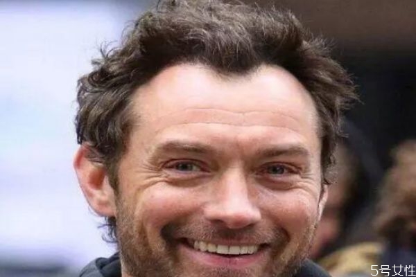 m字型發(fā)際線怎么辦 m型發(fā)際線一定會禿頂嗎 m字型發(fā)際線怎么辦 m型發(fā)際線一定會禿頂嗎