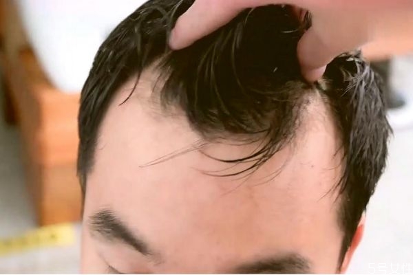 m字型發(fā)際線怎么辦 m型發(fā)際線一定會禿頂嗎 m字型發(fā)際線怎么辦 m型發(fā)際線一定會禿頂嗎