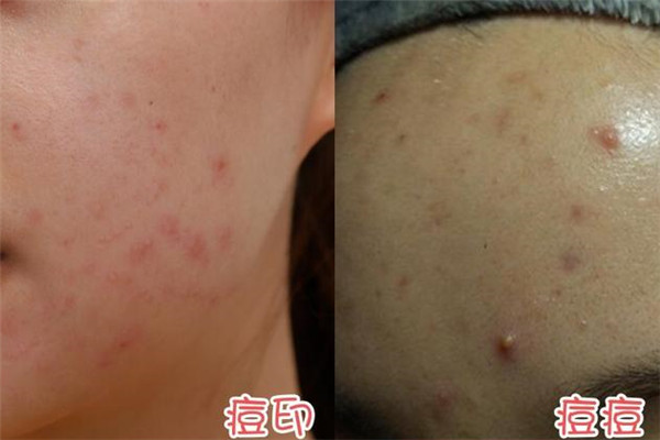 我的皮膚老是長痘痘是什么原因呢 我的皮膚老是長痘痘是什么原因呢