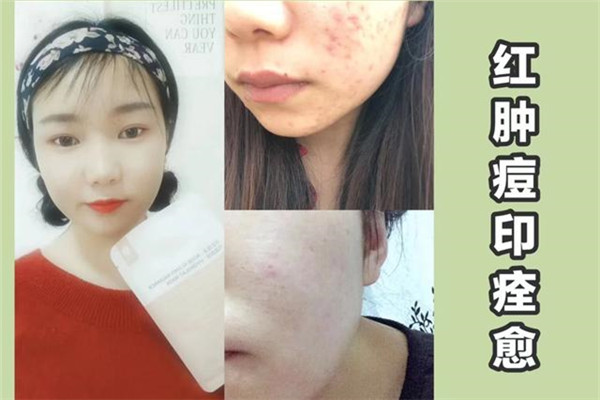 我的皮膚老是長痘痘是什么原因呢 我的皮膚老是長痘痘是什么原因呢