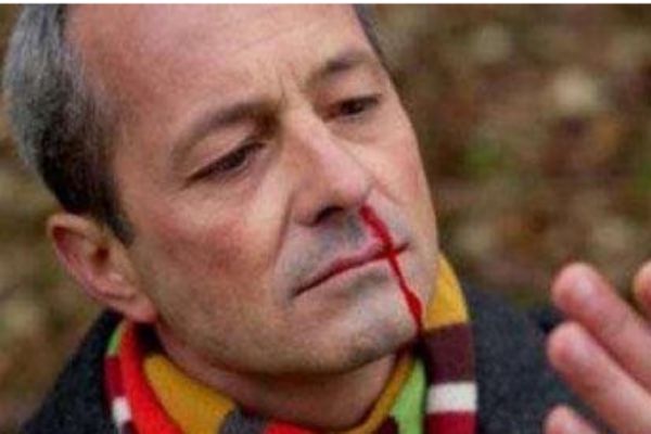 經(jīng)常流鼻血是怎么回事 經(jīng)常流鼻血怎么辦 經(jīng)常流鼻血是怎么回事 經(jīng)常流鼻血怎么辦