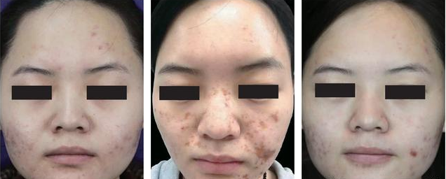 甘醇酸60可以刷臉嗎 在家用甘醇酸刷酸教程 甘醇酸60可以刷臉嗎 在家用甘醇酸刷酸教程