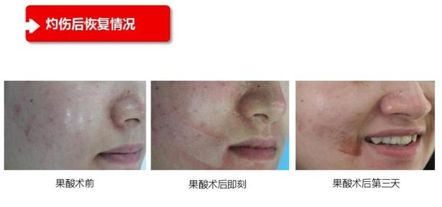 甘醇酸60可以刷臉嗎 在家用甘醇酸刷酸教程 甘醇酸60可以刷臉嗎 在家用甘醇酸刷酸教程