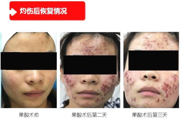 甘醇酸60可以刷臉嗎 在家用甘醇酸刷酸教程 甘醇酸60可以刷臉嗎 在家用甘醇酸刷酸教程