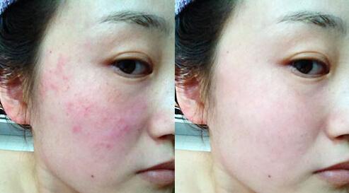 敏感肌怎么判斷 敏感肌膚修復(fù)方法 敏感肌怎么判斷 敏感肌膚修復(fù)方法