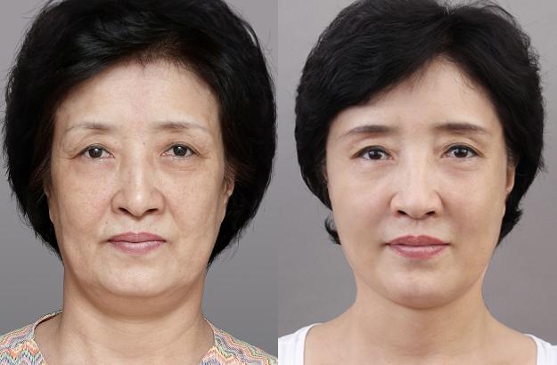 緊致皮膚最有效的方法 緊致皮膚除皺的方法 緊致皮膚最有效的方法 緊致皮膚除皺的方法