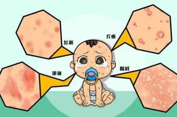 嬰兒濕疹是胎毒嗎 嬰兒濕疹是怎么形成的 嬰兒濕疹是胎毒嗎 嬰兒濕疹是怎么形成的