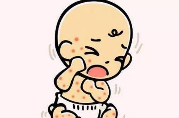 嬰兒濕疹是胎毒嗎 嬰兒濕疹是怎么形成的 嬰兒濕疹是胎毒嗎 嬰兒濕疹是怎么形成的