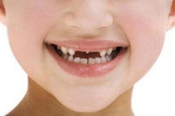 兒童換牙是全部都換嗎 兒童換牙幾歲開始換 兒童換牙是全部都換嗎 兒童換牙幾歲開始換