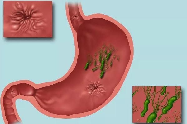 胃潰瘍要吃多久的藥才能修復 胃潰瘍要做活檢嗎 胃潰瘍要吃多久的藥才能修復 胃潰瘍要做活檢嗎