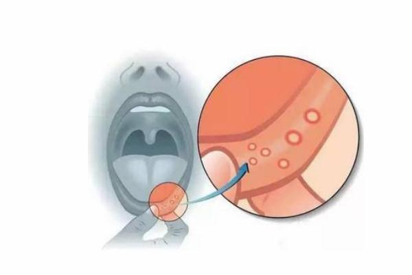 口腔潰瘍?yōu)槭裁催@么疼 口腔潰瘍?yōu)槭裁词前椎? alt=