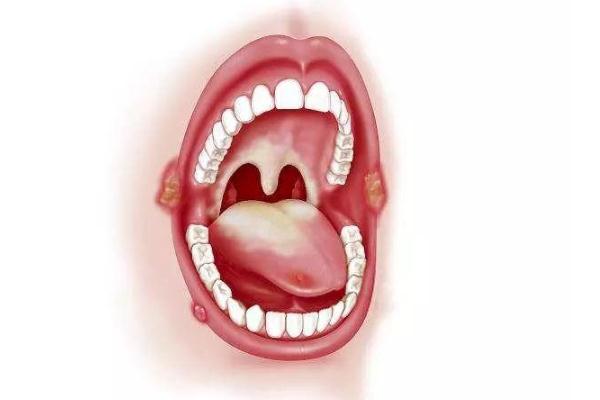 口腔潰瘍的早期癥狀 口腔潰瘍的表現(xiàn)癥狀 口腔潰瘍的早期癥狀 口腔潰瘍的表現(xiàn)癥狀