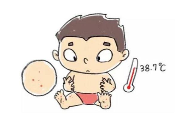 蕁麻疹是否有傳染 蕁麻疹是屬于過敏體質(zhì)嗎 蕁麻疹是否有傳染 蕁麻疹是屬于過敏體質(zhì)嗎