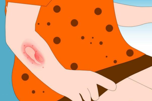 蕁麻疹可以吹風(fēng)不 蕁麻疹可以吃魚嗎 蕁麻疹可以吹風(fēng)不 蕁麻疹可以吃魚嗎