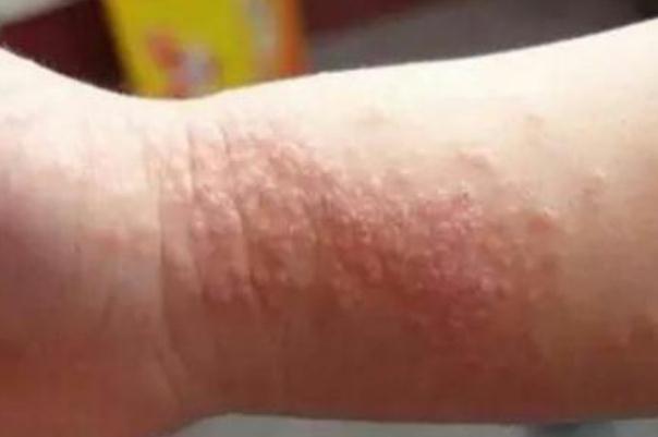 新生兒濕疹可以擦潤膚霜嗎 新生兒濕疹可以洗澡不 新生兒濕疹可以擦潤膚霜嗎 新生兒濕疹可以洗澡不