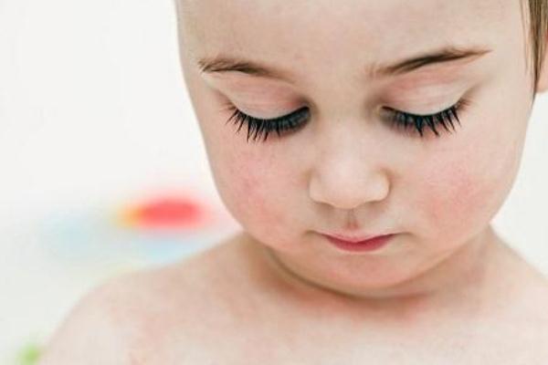 新生兒濕疹是熱出來的嗎 新生兒濕疹是胎毒引起的嗎 新生兒濕疹是熱出來的嗎 新生兒濕疹是胎毒引起的嗎