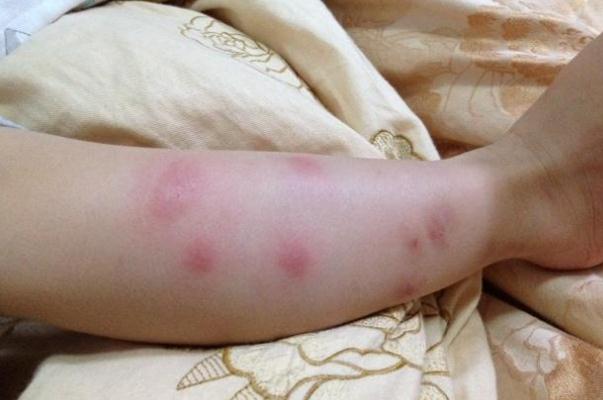 新生兒濕疹能曬太陽(yáng)嗎 新生兒濕疹能用碘伏嗎 新生兒濕疹能曬太陽(yáng)嗎 新生兒濕疹能用碘伏嗎