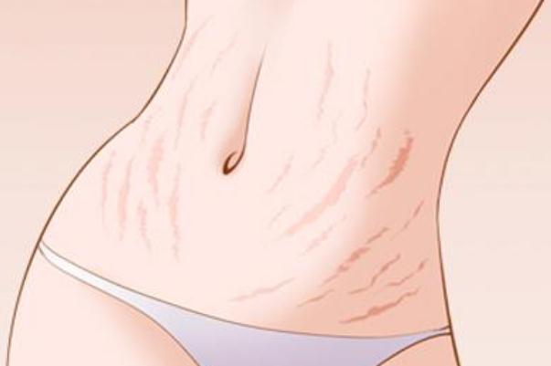 妊娠紋可以完全修復(fù)嗎 怎樣去除妊辰紋妙招 妊娠紋可以完全修復(fù)嗎 怎樣去除妊辰紋妙招