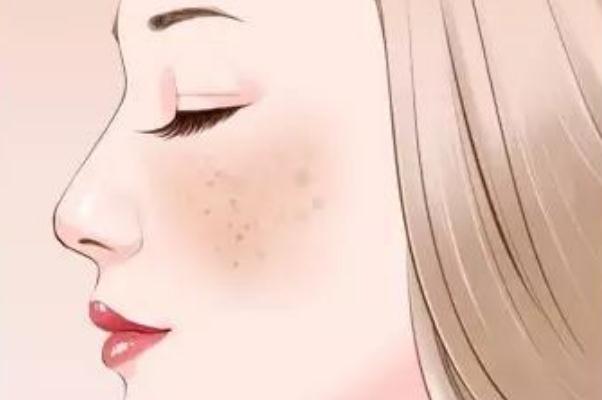 妊娠斑是怎么形成的 妊娠斑怎么調(diào)理可以淡斑 妊娠斑是怎么形成的 妊娠斑怎么調(diào)理可以淡斑