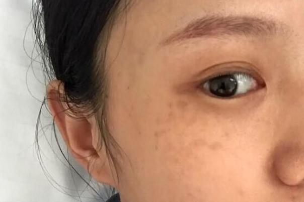 妊娠斑怎么才能祛除 妊娠斑產(chǎn)后多久能消失 妊娠斑怎么才能祛除 妊娠斑產(chǎn)后多久能消失