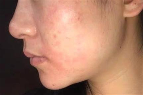 敏感肌臉部發(fā)紅怎么修復 敏感肌怎么修復成正常肌膚 敏感肌臉部發(fā)紅怎么修復 敏感肌怎么修復成正常肌膚