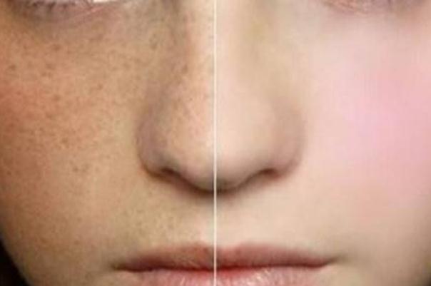 妊娠斑怎么才能祛除 妊娠斑產(chǎn)后多久能消失 妊娠斑怎么才能祛除 妊娠斑產(chǎn)后多久能消失