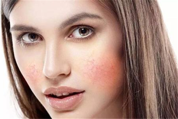 敏感肌臉部發(fā)紅怎么修復 敏感肌怎么修復成正常肌膚 敏感肌臉部發(fā)紅怎么修復 敏感肌怎么修復成正常肌膚