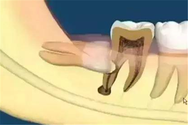 智齒發(fā)炎的時(shí)候可以拔嗎 智齒發(fā)炎的癥狀有哪些 智齒發(fā)炎的時(shí)候可以拔嗎 智齒發(fā)炎的癥狀有哪些