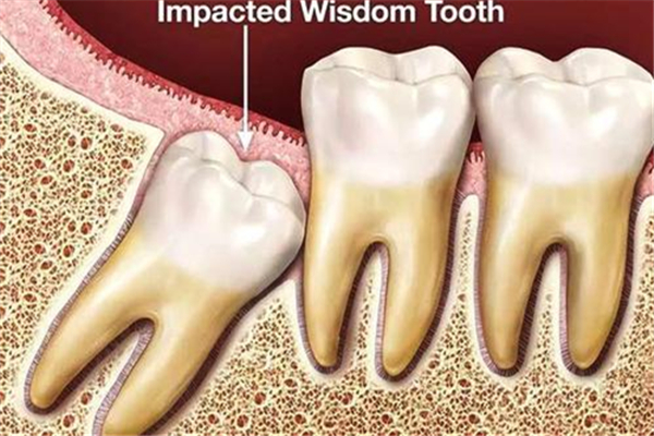 智齒什么年齡段會長 智齒是一下子長出來的嗎 智齒什么年齡段會長 智齒是一下子長出來的嗎