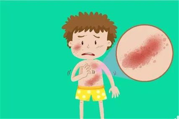 濕氣重會引起蕁麻疹嗎 濕氣重會引起皮膚病嗎 濕氣重會引起蕁麻疹嗎 濕氣重會引起皮膚病嗎