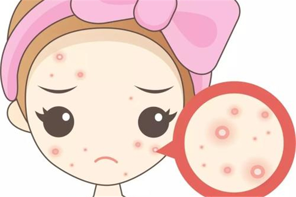 痘痘肌適合用什么洗面奶 痘痘肌膚怎么調(diào)理小常識(shí) 痘痘肌適合用什么洗面奶 痘痘肌膚怎么調(diào)理小常識(shí)