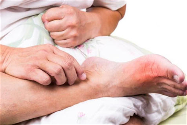 尿酸高會(huì)引起什么疾病 尿酸高的危害 尿酸高會(huì)引起什么疾病 尿酸高的危害