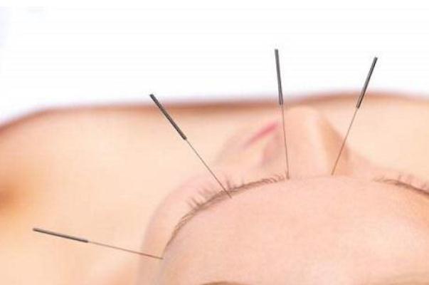 針灸可以去濕氣嗎 針灸可以每天做嗎 針灸可以去濕氣嗎 針灸可以每天做嗎