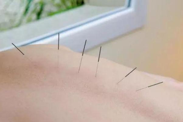 針灸有危險嗎 針灸有什么好處和壞處 針灸有危險嗎 針灸有什么好處和壞處