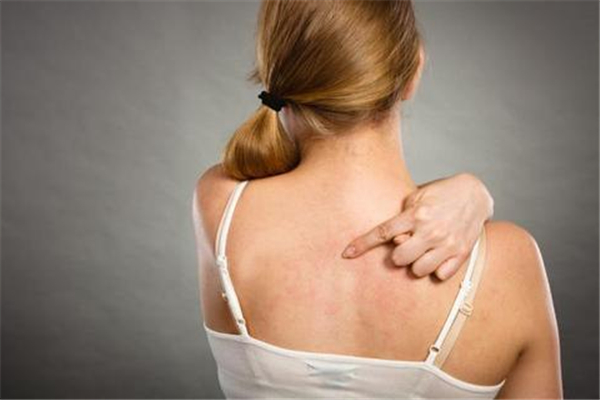 蕁麻疹會(huì)導(dǎo)致手指腫嗎 蕁麻疹的危害 蕁麻疹會(huì)導(dǎo)致手指腫嗎 蕁麻疹的危害