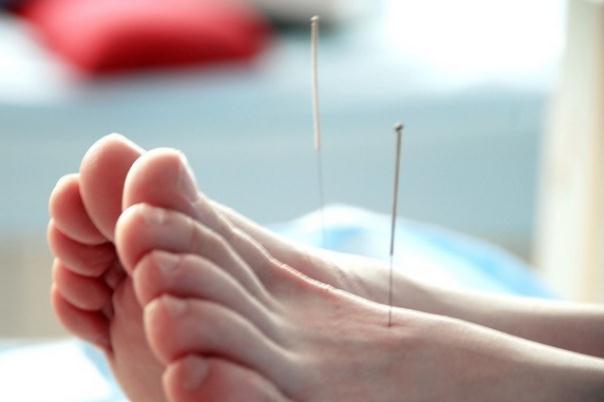 針灸會(huì)影響月經(jīng)推遲嗎 針灸會(huì)導(dǎo)致月經(jīng)不調(diào)嗎 針灸會(huì)影響月經(jīng)推遲嗎 針灸會(huì)導(dǎo)致月經(jīng)不調(diào)嗎