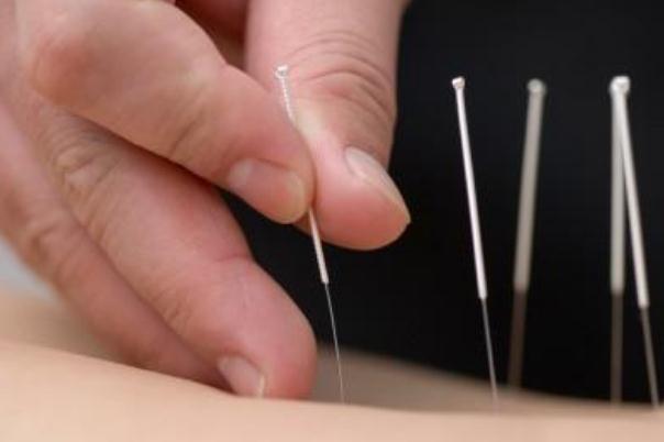 針灸治療失眠效果如何 針灸治療失眠一般多久有明顯效果 針灸治療失眠效果如何 針灸治療失眠一般多久有明顯效果