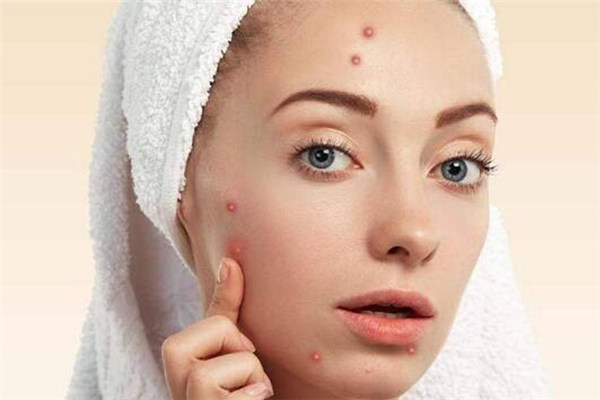 上火會(huì)長痘痘嗎 上火長痘痘怎么調(diào)理 上火會(huì)長痘痘嗎 上火長痘痘怎么調(diào)理