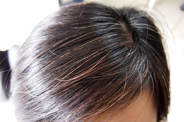 氣血不足會(huì)長(zhǎng)白發(fā)嗎 氣血不足會(huì)掉頭發(fā)嗎 氣血不足會(huì)長(zhǎng)白發(fā)嗎 氣血不足會(huì)掉頭發(fā)嗎