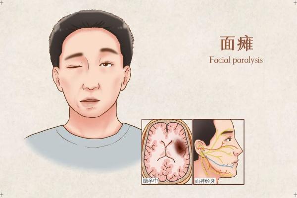 面癱針灸多久會好 面癱針灸治療最佳時間 面癱針灸多久會好 面癱針灸治療最佳時間